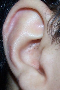 acne comedonnienne oreille