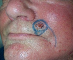 Carcinome baso-cellulaire bourgeonnant de la lèvre : dessin du lambeau