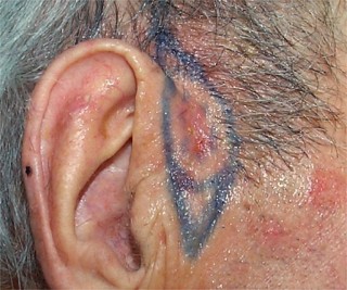 Carcinome basocellulaire de la joue cicatrice inflammatoire 1