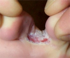 mycose des plis des orteils