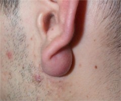 Inflammation d'un kyste sébacé du lobule de l'oreille