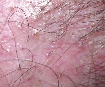 Lichen plan du cuir chevelu : vue macroscopique de l'hyperkératose folliculaire
