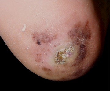 melanome du talon invasif et ulcéré