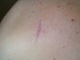 Naevus du dos cicatrice moyenne à 2 mois