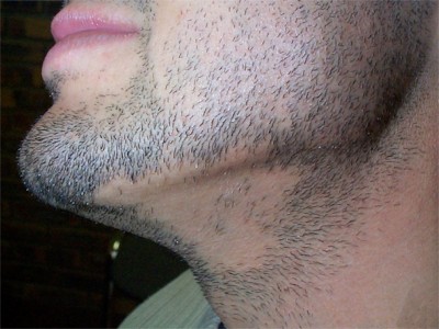 Pelade de la barbe
