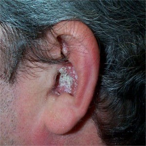 Psoriasis de l'oreille