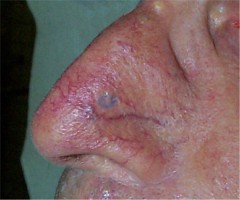 carcinome de l'aile du nez : Repérage et biopsie