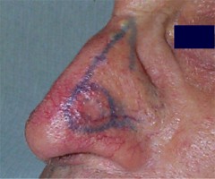 Carcinome du nez : dessin de l'exérèse et du lambeau sail-flap