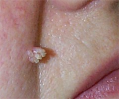 Papillome verruqueux à HPV 2